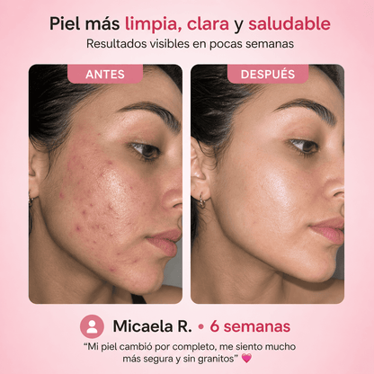 DermaSkin | Tratamiento para granitos y textura