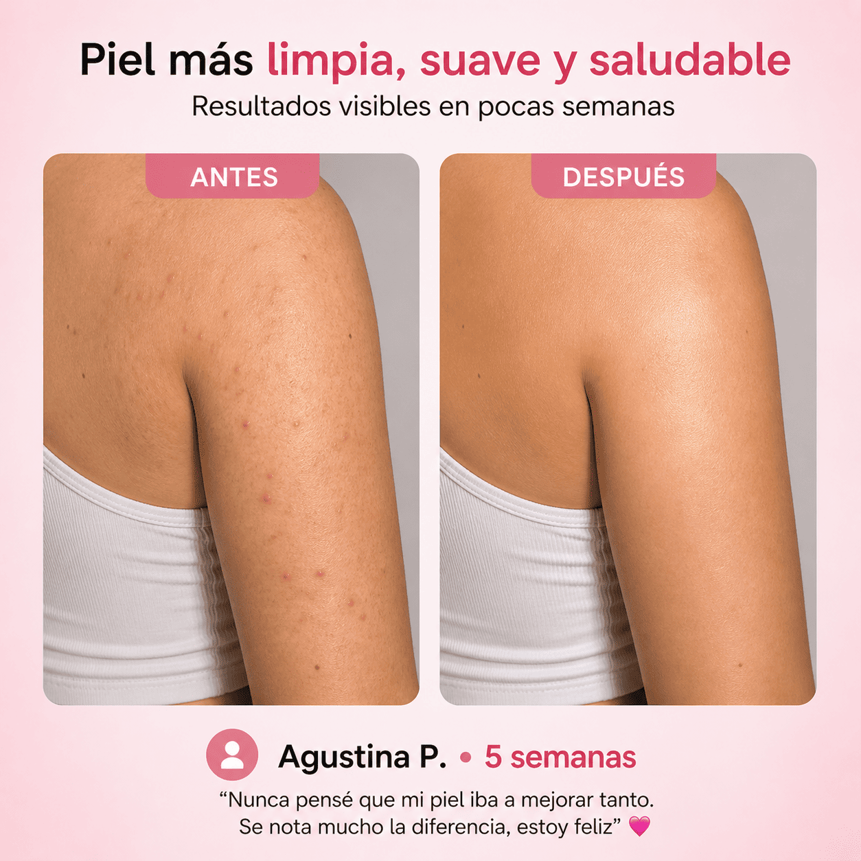 DermaSkin | Tratamiento para granitos y textura