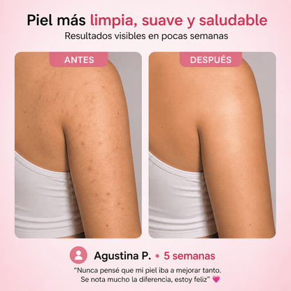 DermaSkin | Tratamiento para granitos y textura