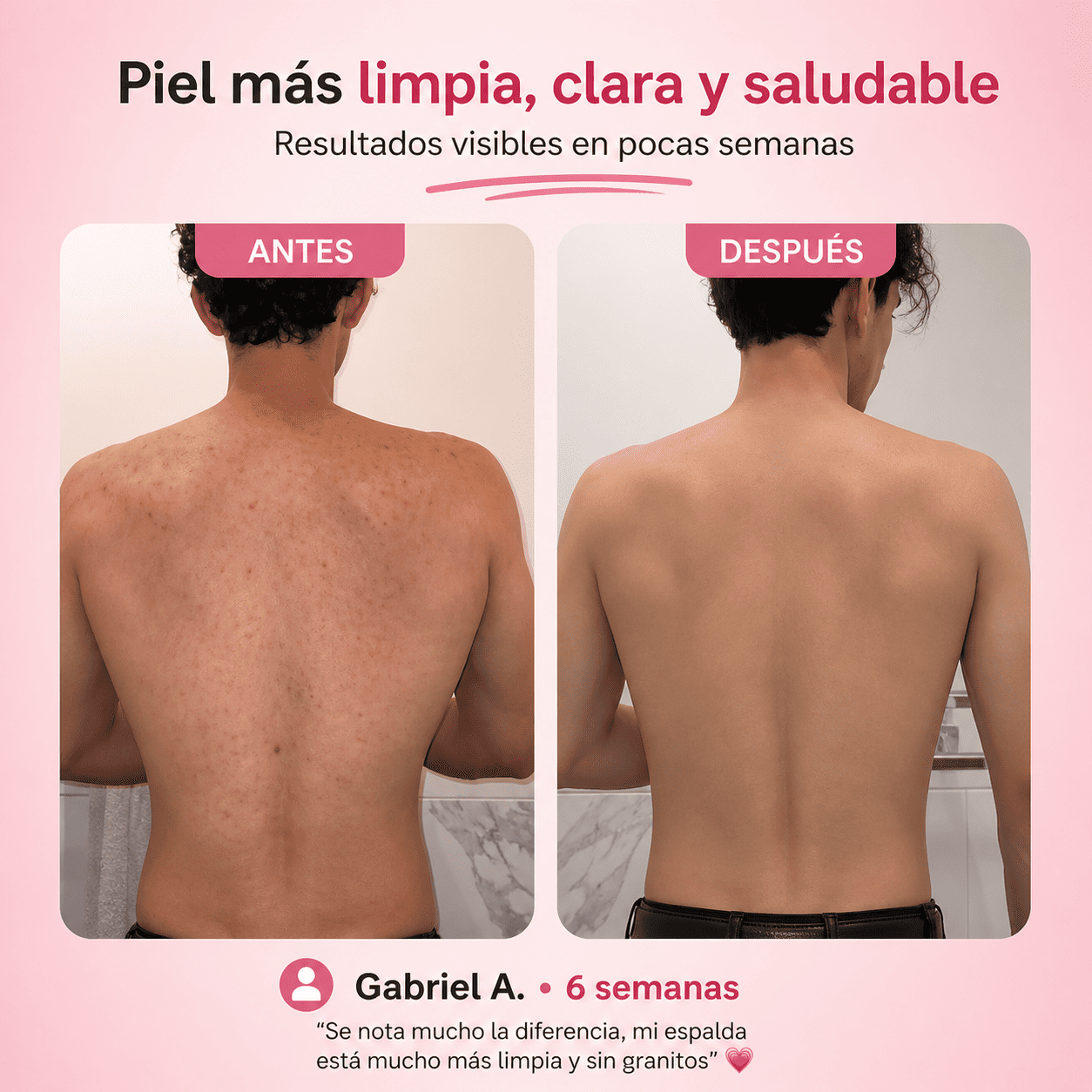 DermaSkin | Tratamiento para granitos y textura